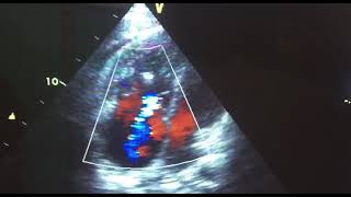 Right ventricular dualthrombi attaching to the chordae tendineae a case report [upl. by Hatch898]