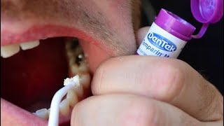 How To Fix a Broken Tooth with Dentemp or DenTek Tooth Filling and Crown Repair [upl. by Rebor]