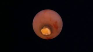 Multiple Submandibular duct stone Sialendoscopy [upl. by Aicillyhp]