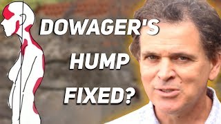 How To Fix Dowagers Hump [upl. by Wohlert]