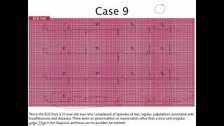 32 EKG sick sinus syndrome case  ករណីសិក្សារ ECG លើអ្នកជំងឺមាន SSS [upl. by Etta]