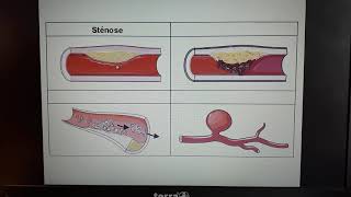 1ST2S Vidéo 5 lathérosclérose [upl. by Ankney400]