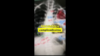 Pneumonia complicadíssima [upl. by Lucais825]