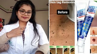 Wart Remover Ointment Wart Remover honest review  Wart Remover Cream benefits uses review in hindi [upl. by Miahc]