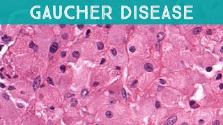 Gaucher disease involving bone lysosomal storage disorder glucocerebrosidase deficiency pathology [upl. by Euqinitram]