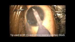 How to Beat Reverse Pupillary Block During Phaco Chris Teng MD [upl. by Zakarias]