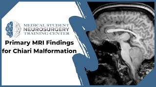 Primary MRI Findings for Chiari Malformation [upl. by Weasner]