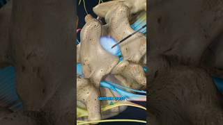 Lumbar Epidural Steroid Injection 3D Animation [upl. by Llenaej119]