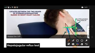 jugular venous pressure osce inspect neck veins [upl. by Grady475]