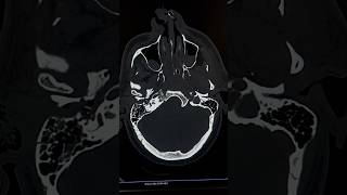 Accident Patient Right Ear Bleed Mean 90 Mastoid Part Fracture accidentallywesanderson [upl. by Grochow]