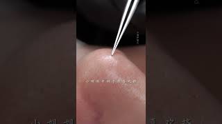 ImmersiveSkinCare Blackheads SkinManagement asmr Facialspa shorts [upl. by Srevart885]