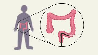 Colorectal cancer screening Arabic [upl. by Obel]