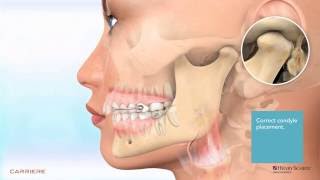 Carriere® Motion™ Appliance for Class II Patient Education Animation 2 [upl. by Earaj]