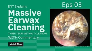 Satisfying Earwax Cleaning 3 Cholesteatoma with Commentary [upl. by Eeuqram]