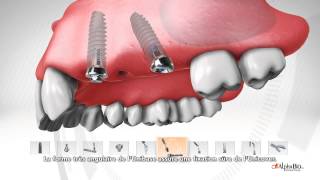 Système de piliers MultiUnit par ALPHABIO TEC [upl. by Tolmann]