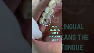 Broken tooth Removed dentist extraction verynicesmiledental [upl. by Assenay]