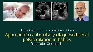 Approach to renal pelvic dilation Antenatal diagnosis of hydronephrosis hydronephrosis ultrasound [upl. by Steen]