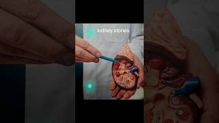 Kidney stones [upl. by Nerok]