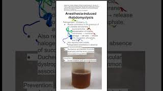 Anesthesiainduced rhabdomyolysis [upl. by Okeim693]