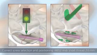 HBS 2 – Minimally invasive palmar surgical technique [upl. by Venus]