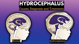 Hydrocephalus Causes Signs and Symptoms Diagnosis and Treatment [upl. by Lenrad]