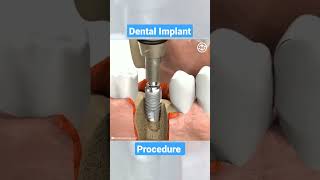 Dental Implant Procedure dental dentist implant animation Shorts [upl. by Nedyarb844]