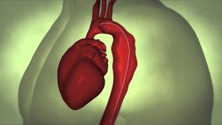 Thoracic Aortic Aneurysm [upl. by Etyak]