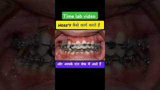 Time Lapse on teeth braces [upl. by Eitten]