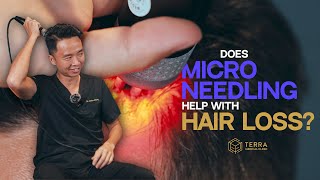 Is Microneedling The Cure For Hair Loss [upl. by Novla]