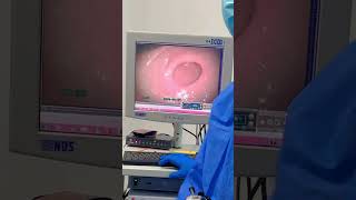 Endoscopia para reflujo y hernia hiatal en niño 10 años pediatria cirugiapediatrica [upl. by Edyak]