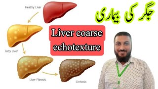 Coarse echotexture liver  chronic liver disease  hepatitis fatty liver [upl. by Amak536]