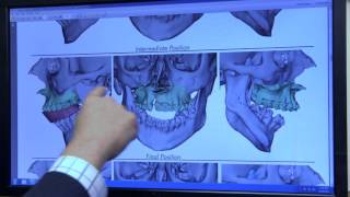 Virtual Surgery Planning [upl. by Imuya]