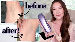 I tried laser hair removal at home this is what happened [upl. by Netsirt]