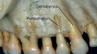 Fenestration amp Dehiscence [upl. by Bigler]