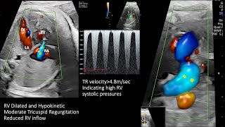 Step by Step analyses of a fetal echo case [upl. by Nirrol]