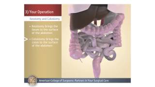 ColostomyIleostomy Your Operation [upl. by Ynhoj]