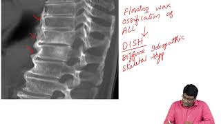 Ankylosing Spondylitis Vs DISH [upl. by Resa720]