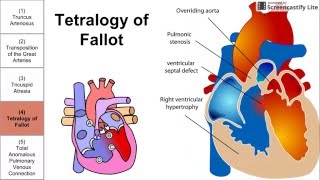 Cyanotic Congenital Heart Diseases [upl. by Eiramrefinnej]