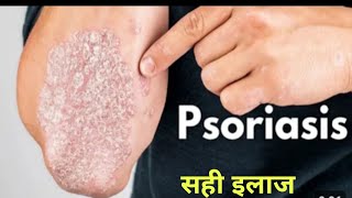 Psoriasis ayurvedic medicine [upl. by Dibb]