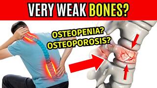 5 TIPS TO IMPROVE OSTEOPENIA and OSTEOPOROSIS  SYMPTOMS OF WEAK BONES [upl. by Emil]