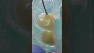 Composite veneers veneers bonding dentistry [upl. by Modern218]