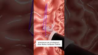 So funktioniert eine Magenverkleinerungsoperation 🤔 [upl. by Junna327]