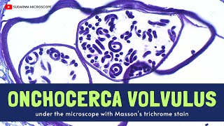 Onchocerca volvulus under the microscope with Massons trichrome stain [upl. by Addis]