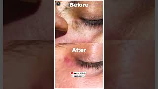 How to Erase Scars in Seconds The Miracle Technique AWISH CLINIC [upl. by Ahsinahs]