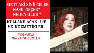 Sırtta Sivilce Neden Çıkar Nasıl Giderilir [upl. by Akimit]