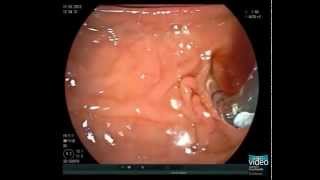 Primary Sclerosing Cholangitis and Brush Cytology Sampling [upl. by Bull]