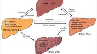 Alcohol And Hypoglycemia  how alcohol causes hypoglycemia [upl. by Lorelle]