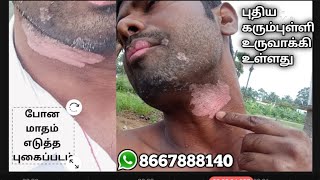 வெண்புள்ளி விரைவில் மறைய இயற்கை வைத்தியம்  vitiligo makeup cream [upl. by Akemat727]