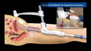 TSPeC® Illustrated Procedure  German [upl. by Shantha]