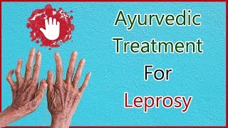 How to cure Leprosy With Ayurveda Symptoms Causes amp Ayurvedic Treatment For Leprosy [upl. by Ecneitap]